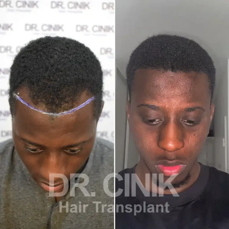 Greffe de cheveux afro avant-après : 3050 greffons