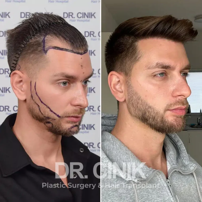 Greffe de barbe avant-après : 4250 greffons