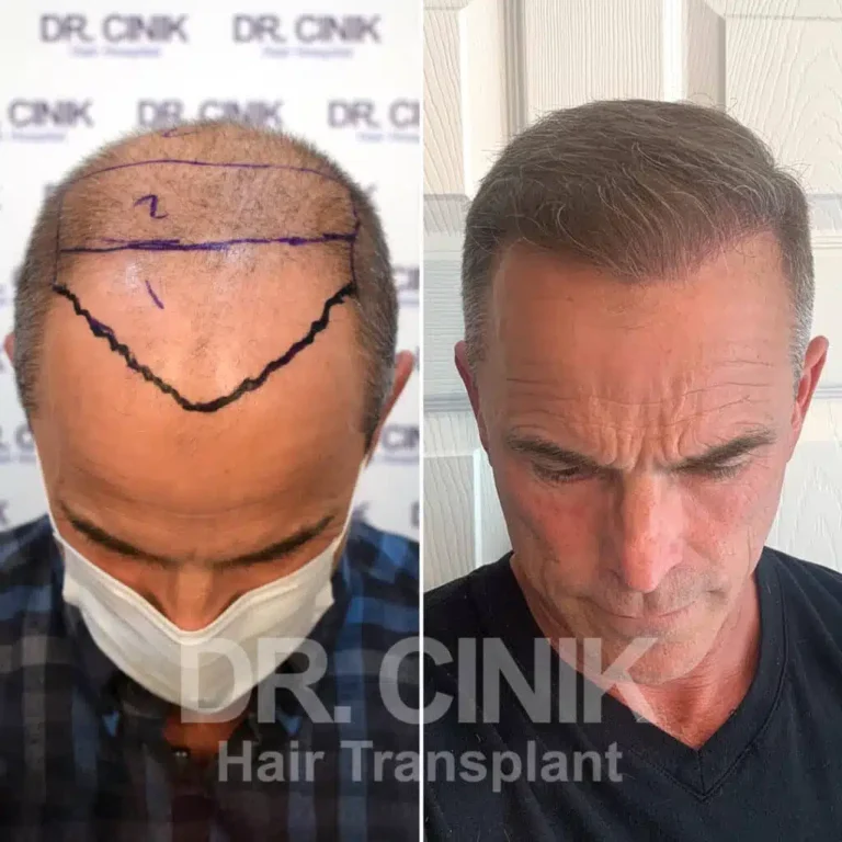 Greffe de cheveux FUE Saphir avant-après : 4800 greffons