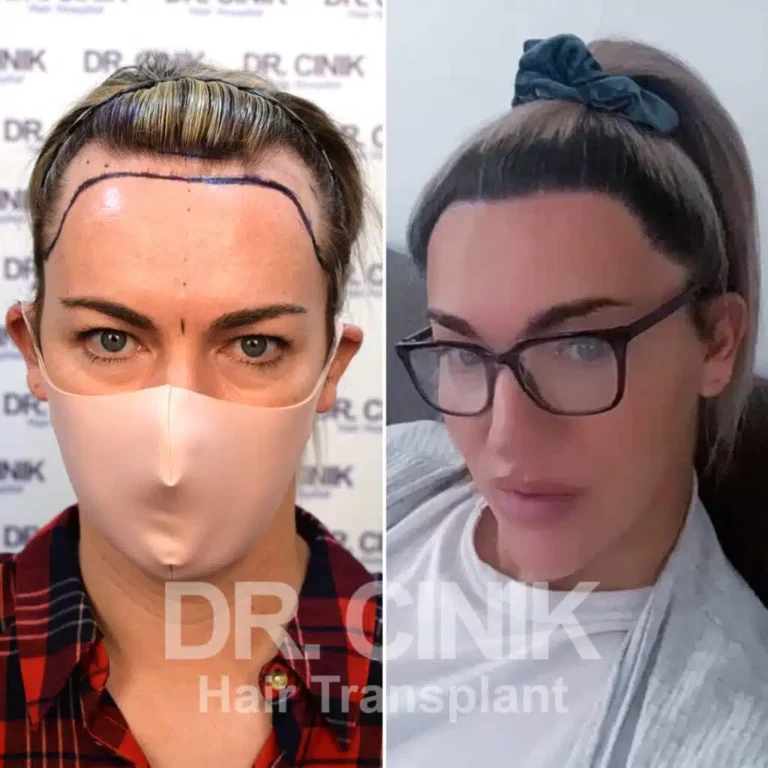 Greffe de cheveux femmes avant-après : 3250 greffons