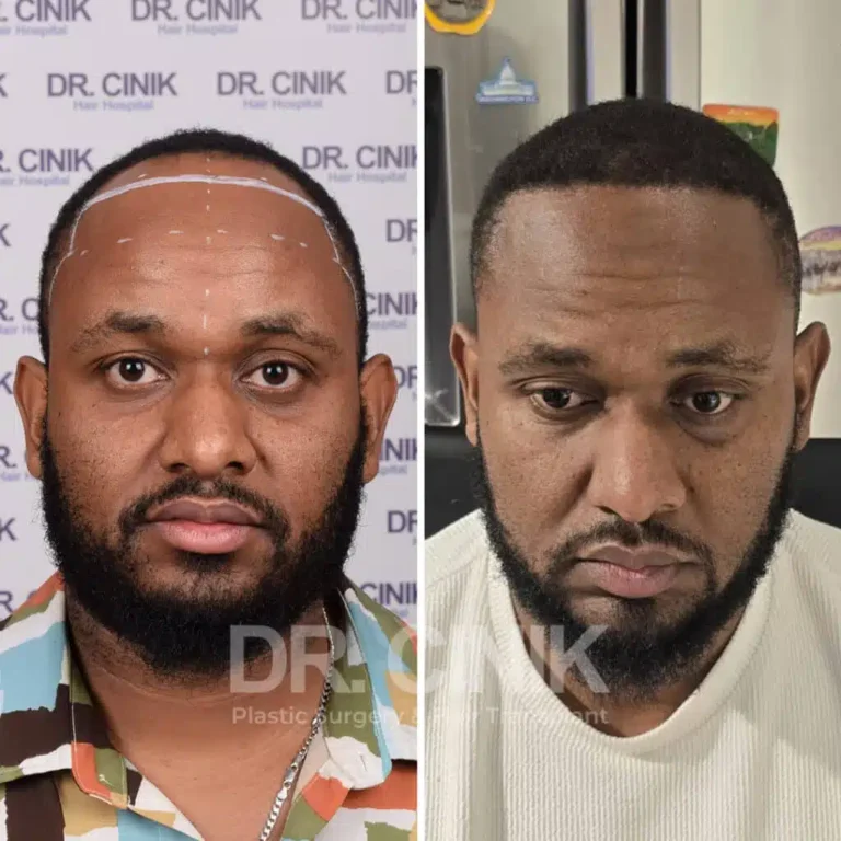 Greffe de cheveux afro avant-après : 3550 greffons