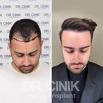 Greffe de cheveux DHI avant-après : 3200 greffons