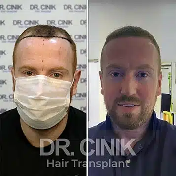 Greffe de cheveux FUE avant-après : 4200 greffons