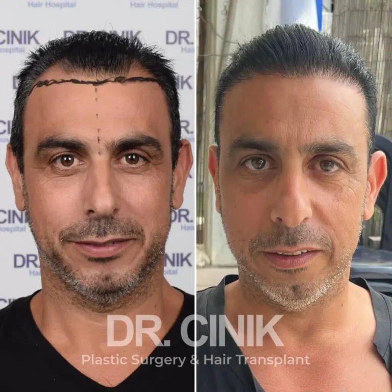 Greffe de cheveux FUE Saphir avant-après : 3700 greffons