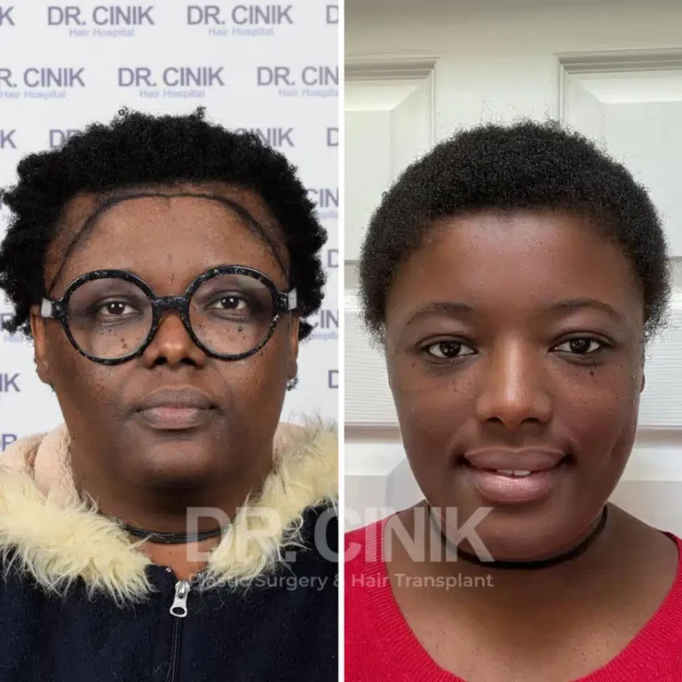 Greffe de cheveux femmes avant-après : 3200 greffons