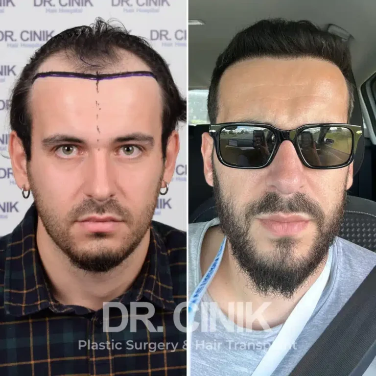 Greffe de cheveux FUE Saphir avant-après : 3600 greffons