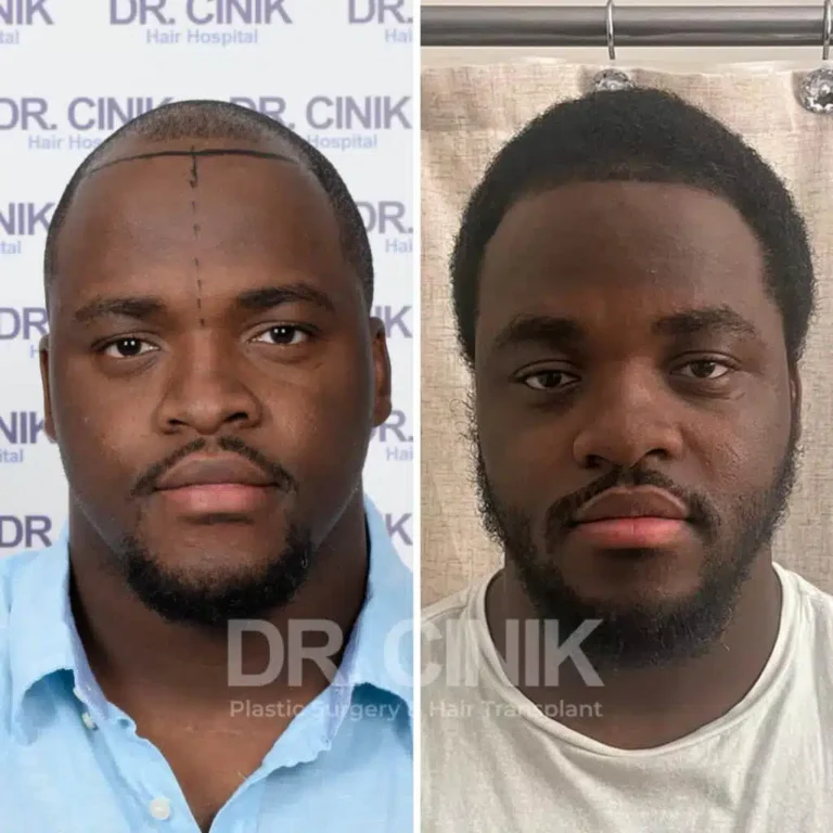 Greffe de cheveux afro avant-après : 2500 greffons