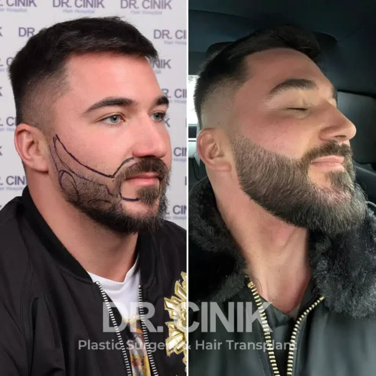 Greffe de barbe avant-après : 2400 greffons