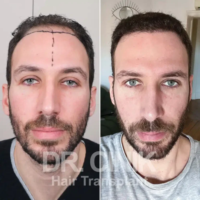 Greffe de cheveux DHI avant-après : 4200 greffons