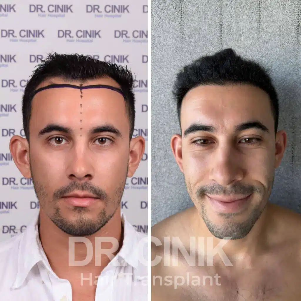 Greffe de cheveux FUE avant-après : 3450 greffons