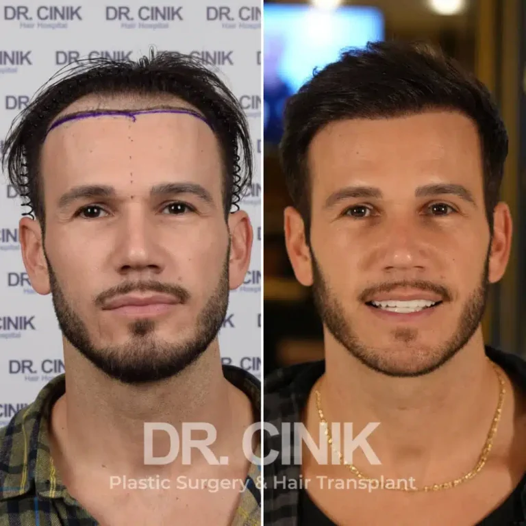 Greffe de cheveux FUE Saphir avant-après : 3750 greffons