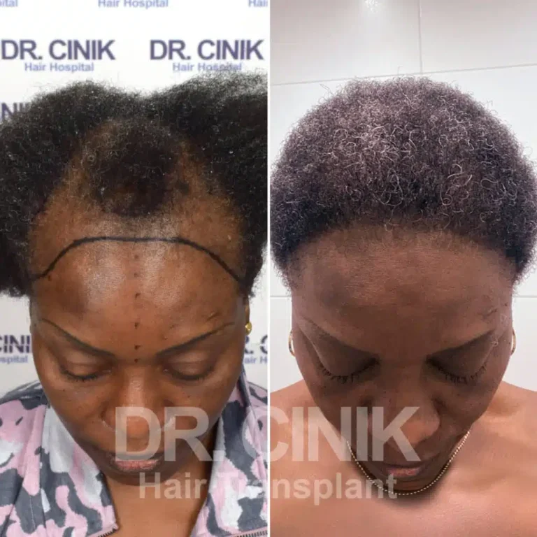 Greffe de cheveux femmes avant-après : 4115 greffons