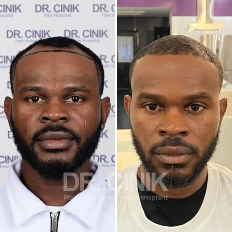 Greffe de cheveux afro avant-après : 2900 greffons