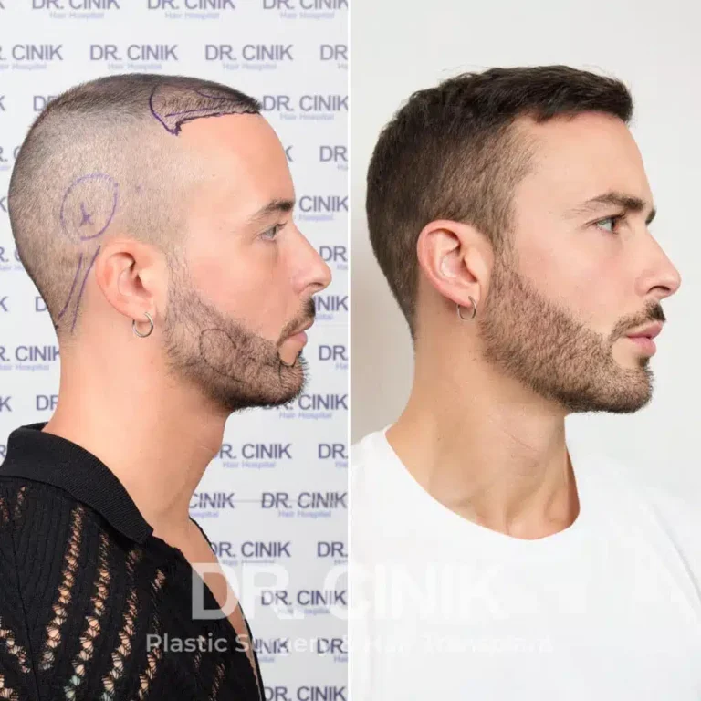 Greffe de barbe avant-après : 3900 greffons