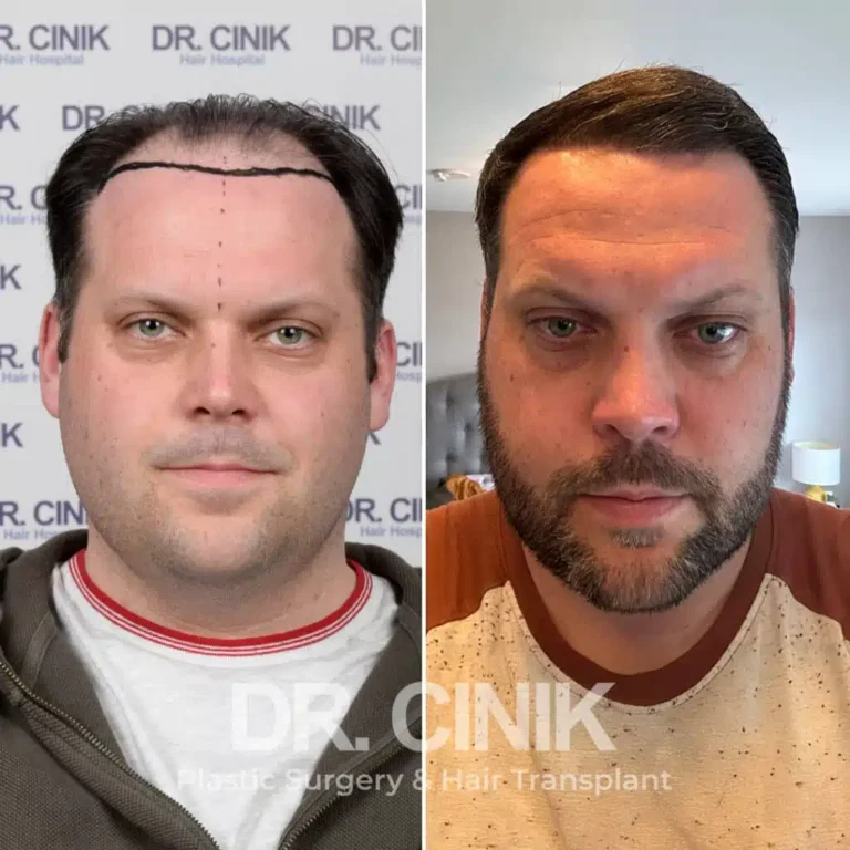 Greffe de cheveux DHI avant-après : 4600 greffons