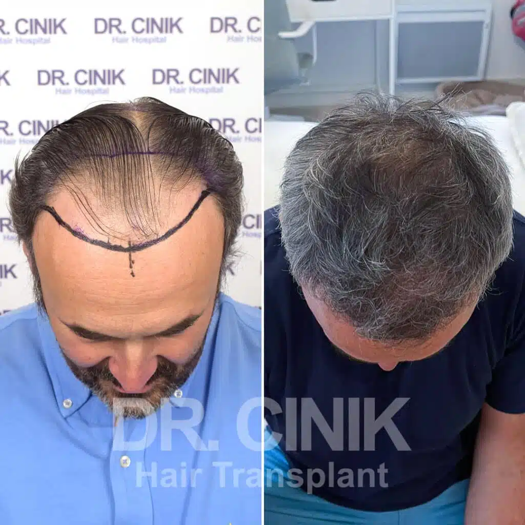 Greffe de cheveux FUE avant-après : 3350 greffons