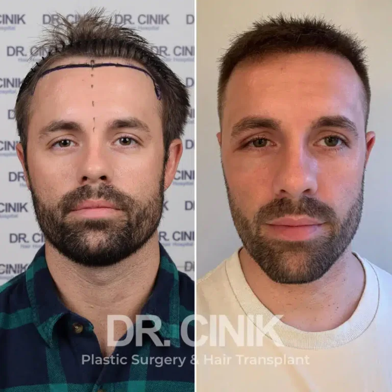 Greffe de cheveux FUE Saphir avant-après : 2800 greffons