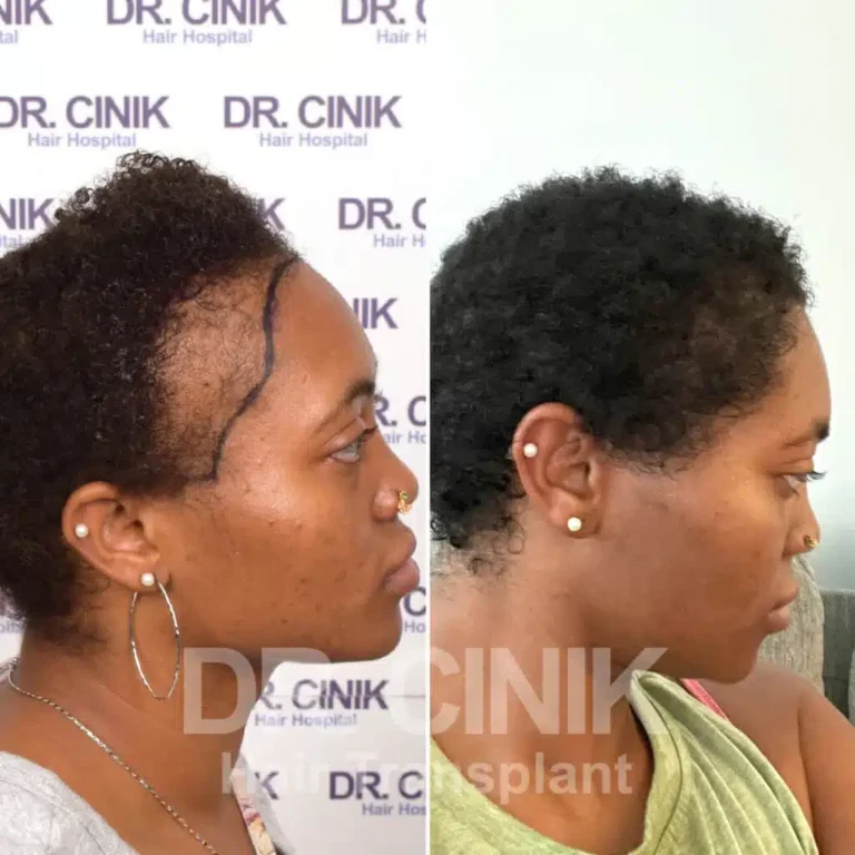 Greffe de cheveux femmes avant-après : 2900 greffons