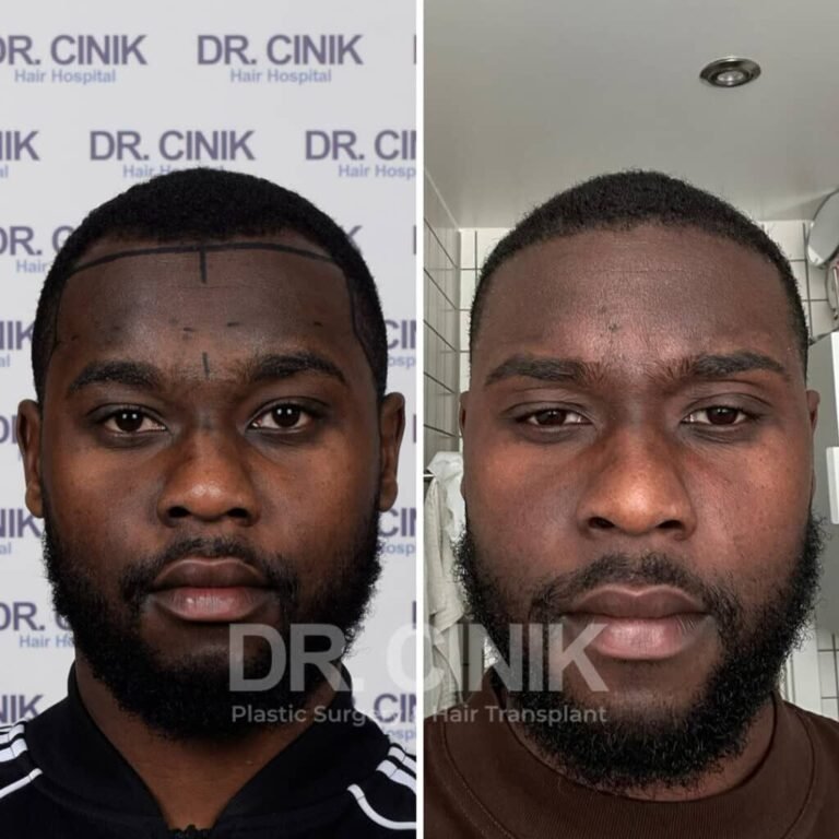 Greffe de cheveux afro avant-après : 2400 greffons