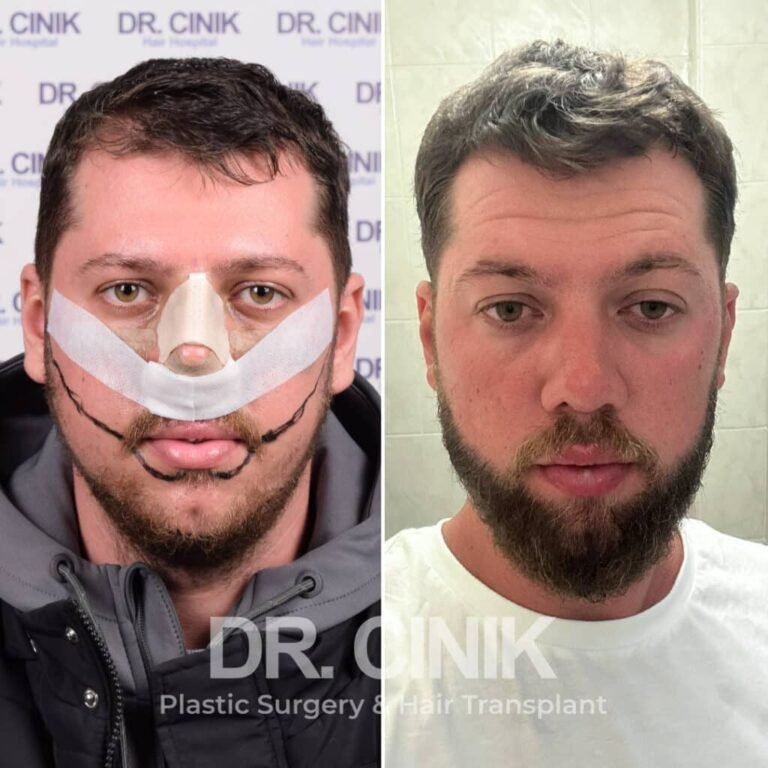 Greffe de barbe avant-après : 3000 greffons