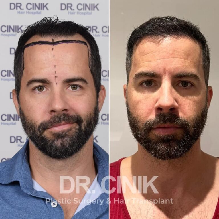 Greffe de cheveux DHI avant-après : 4300 greffons