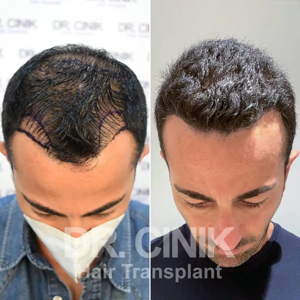 Greffe de cheveux FUE avant-après : 3500 greffons