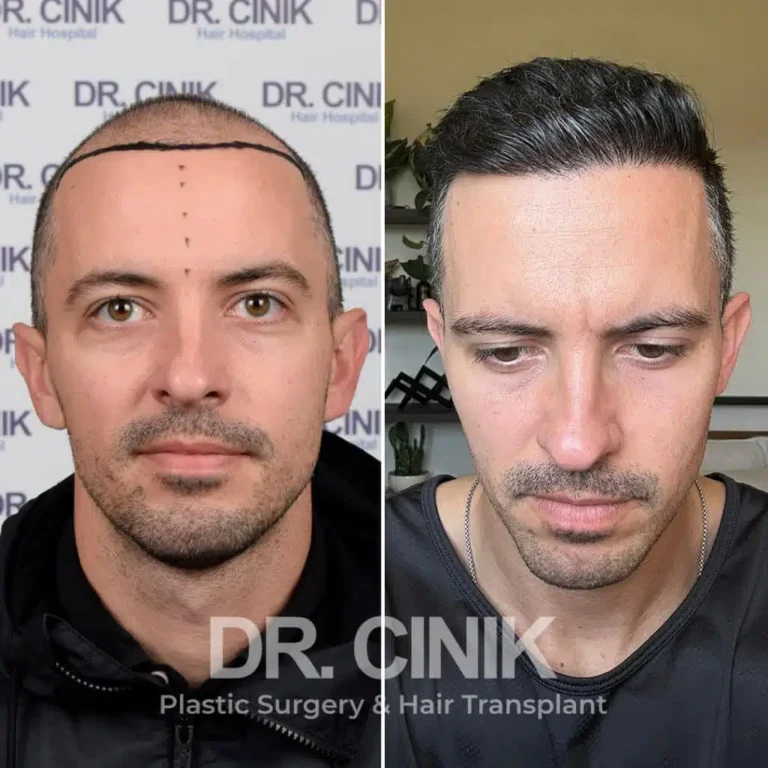 Greffe de cheveux FUE Saphir avant-après : 3300 greffons