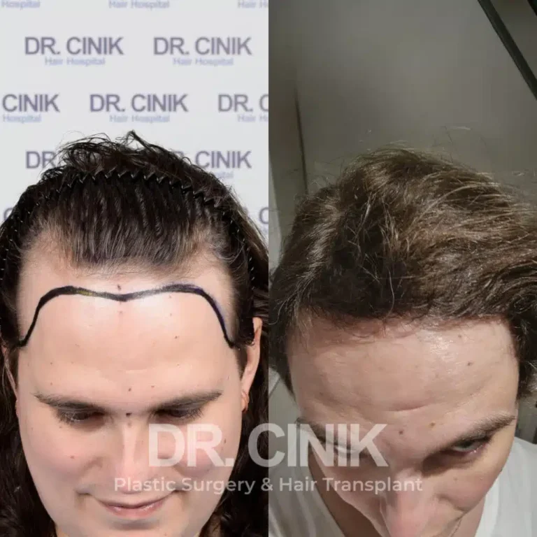 Greffe de cheveux femmes avant-après : 3900 greffons