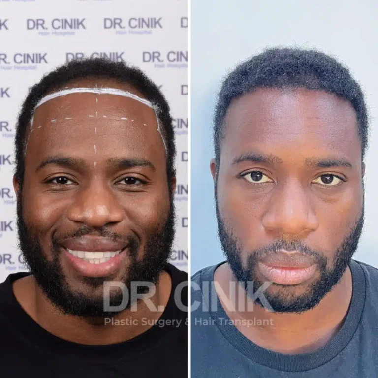 Greffe de cheveux afro avant-après : 3325 greffons