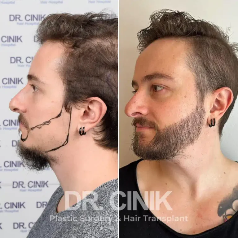 Greffe de barbe avant-après : 3350 greffons