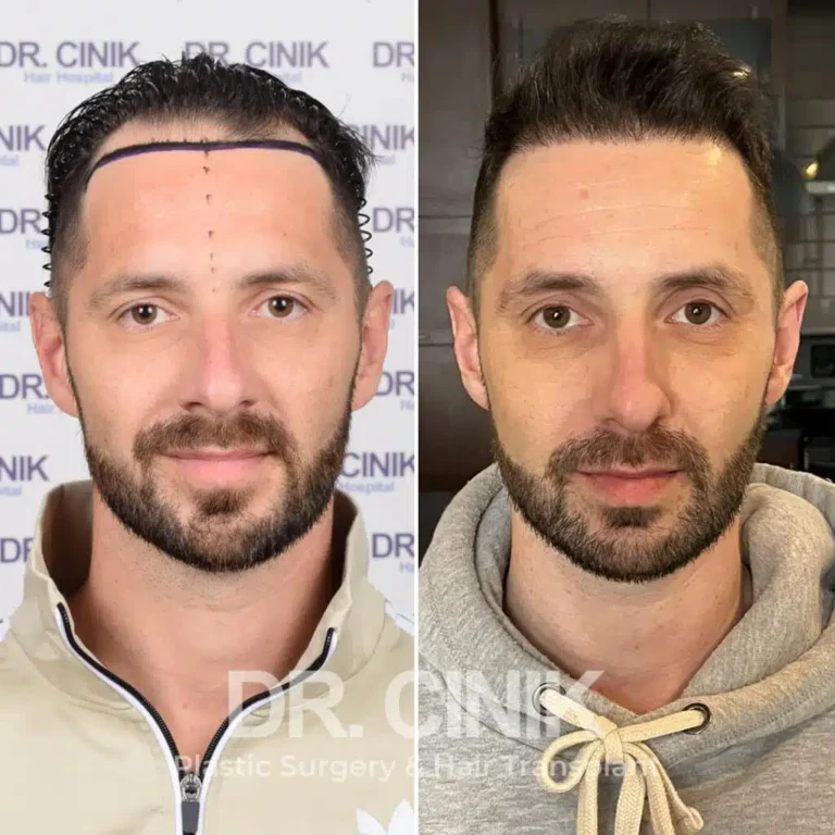 Greffe de cheveux DHI avant-après : 3100 greffons