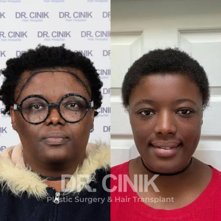 Greffe de cheveux femmes avant-après : 3200 greffons