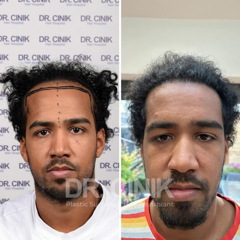 Greffe de cheveux afro avant-après : 3750 greffons