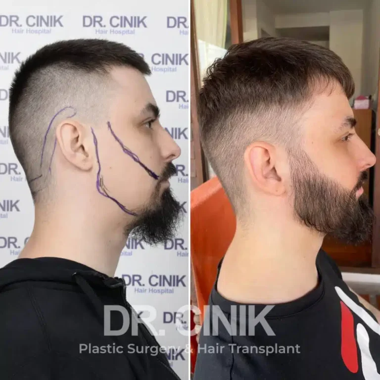 Greffe de barbe avant-après : 3500 greffons