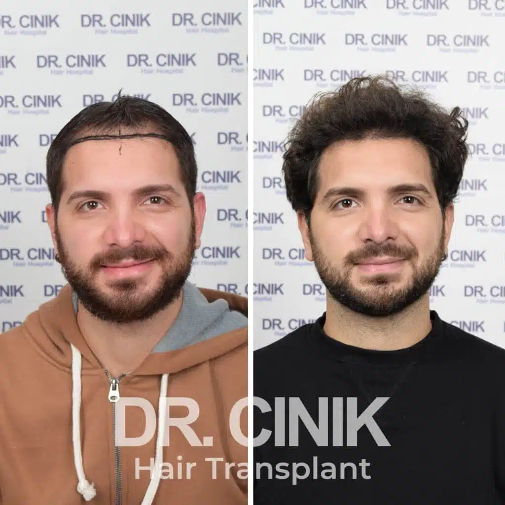 Greffe de cheveux FUE avant-après : 4150 greffons