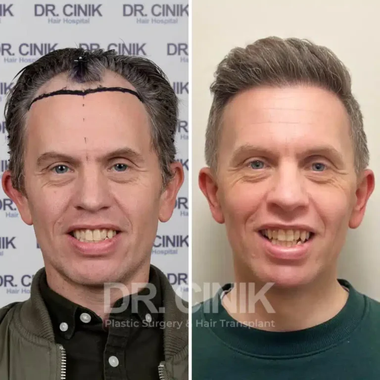 Greffe de cheveux FUE Saphir avant-après : 2800 greffons