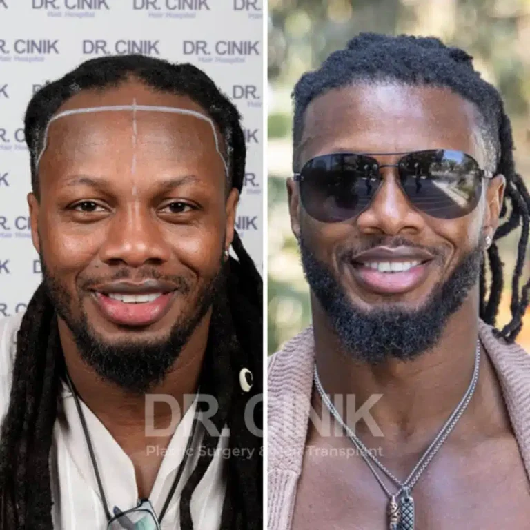 Greffe de cheveux afro avant-après : 2900 greffons