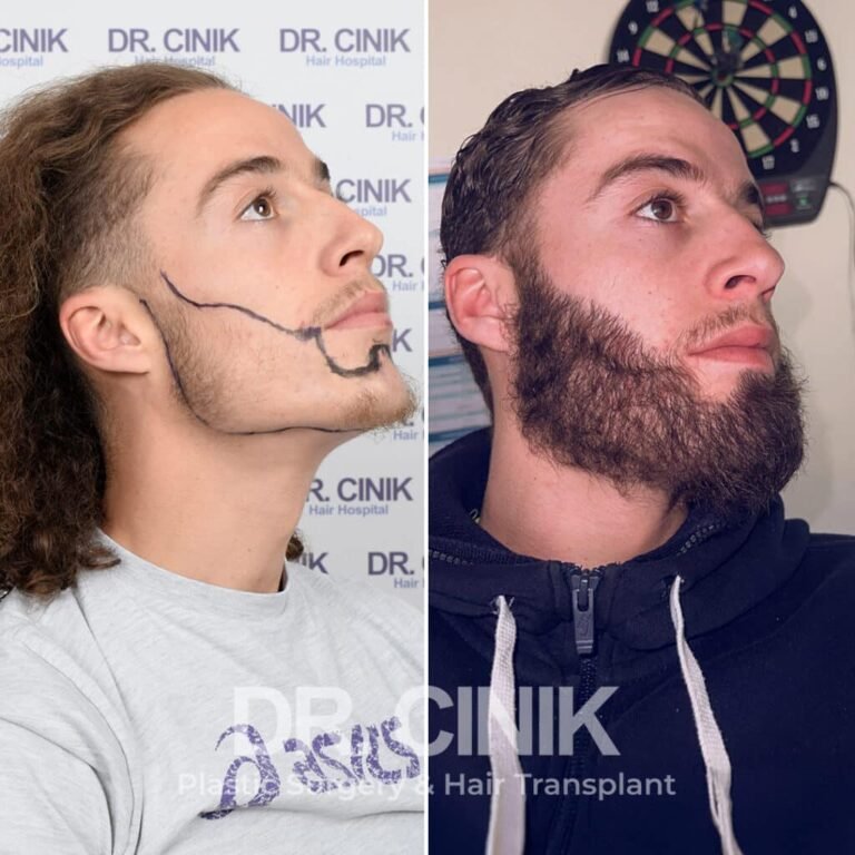 Greffe de barbe avant-après : 3400 greffons