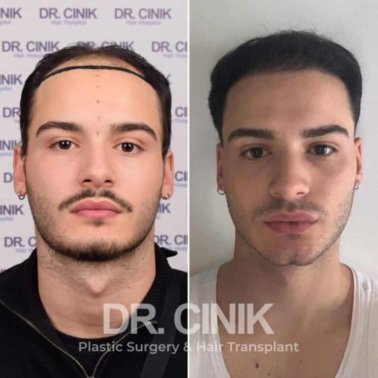 Greffe de cheveux DHI avant-après : 3000 greffons