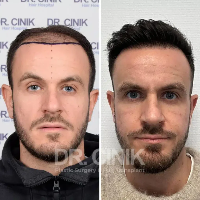 Greffe de cheveux FUE Saphir avant-après : 4200 greffons