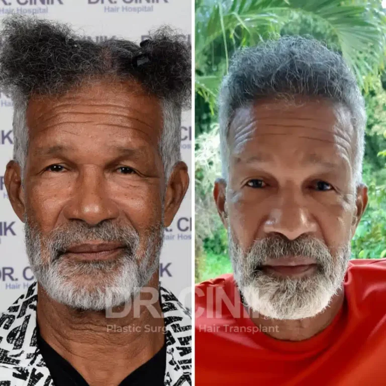 Greffe de cheveux afro avant-après : 3250 greffons