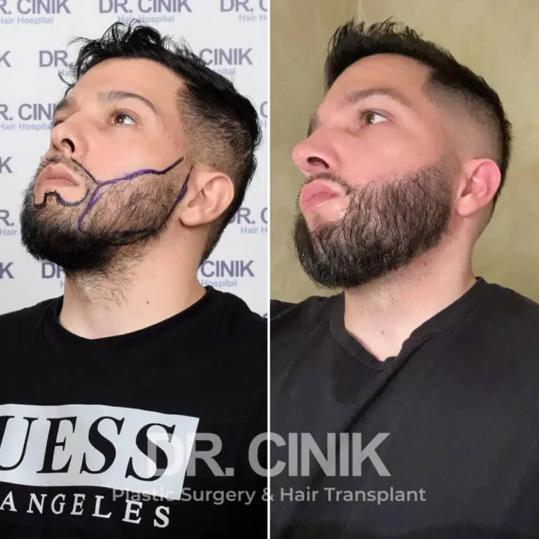 Greffe de barbe avant-après : 3000 greffons