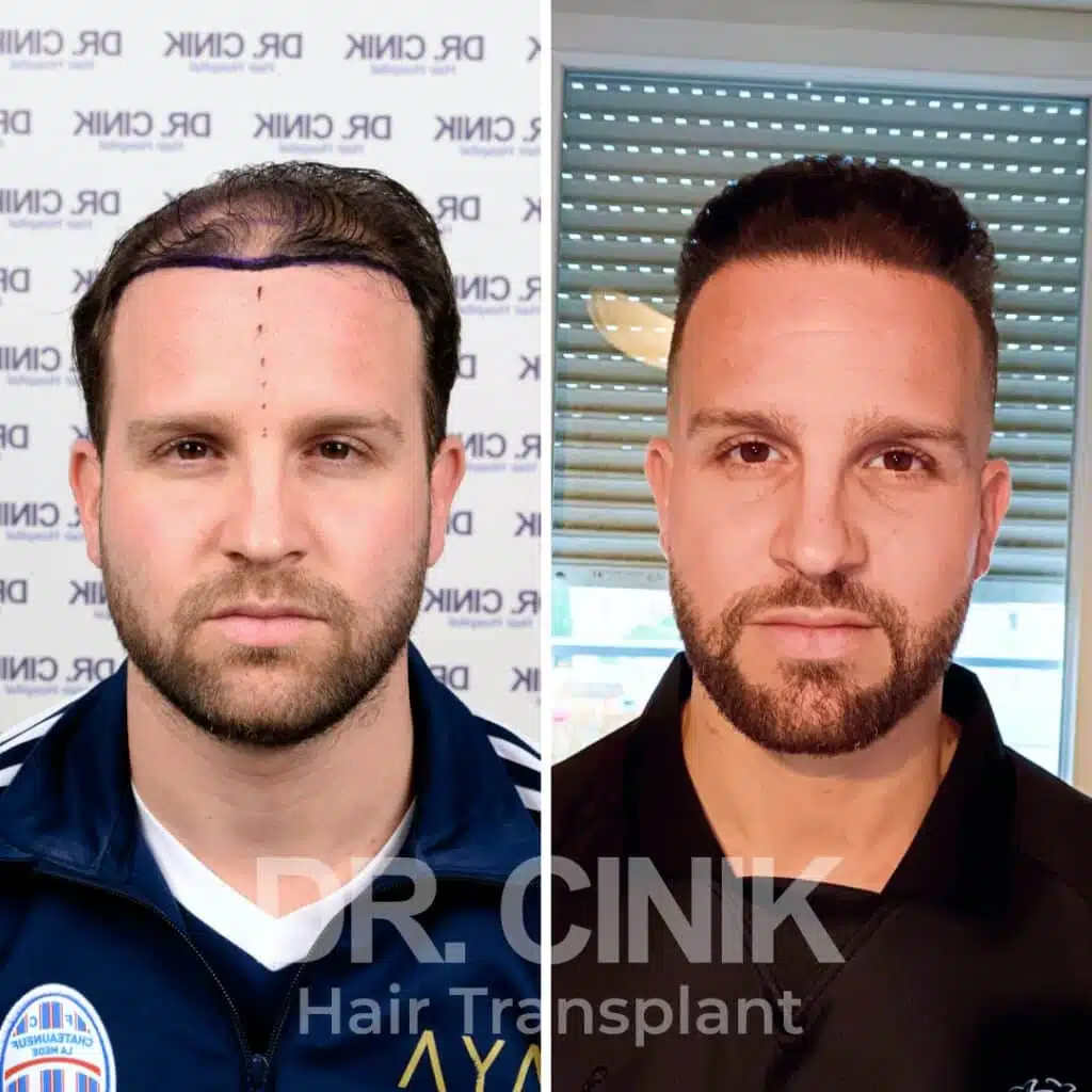 Greffe de cheveux FUE avant-après : 4750 greffons