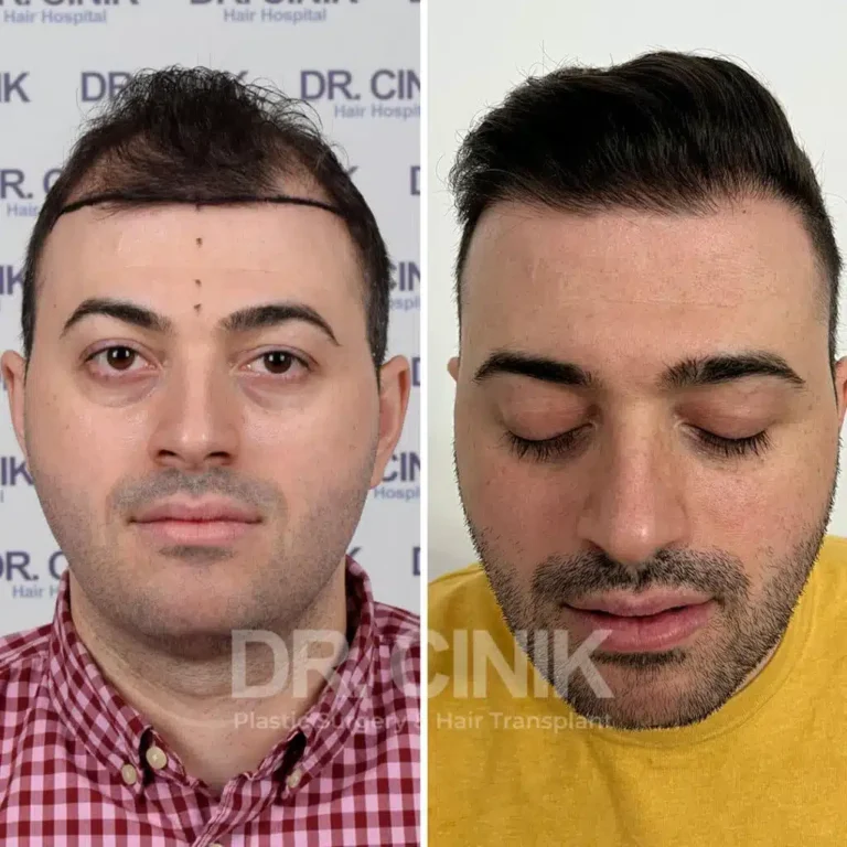 Greffe de cheveux FUE Saphir avant-après : 4200 greffons