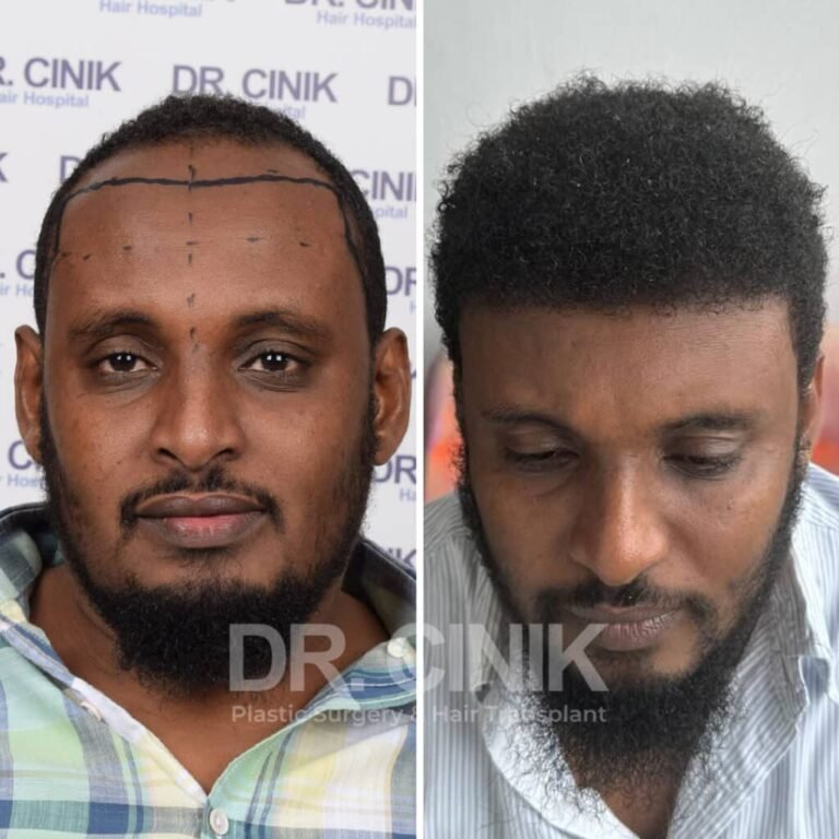 Greffe de cheveux afro avant-après : 3600 greffons