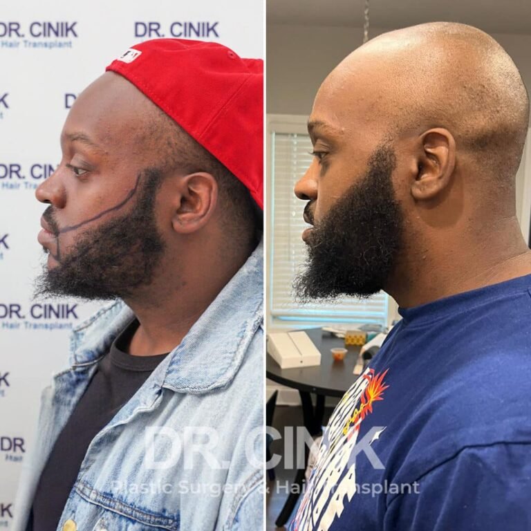 Greffe de barbe avant-après : 2400 greffons