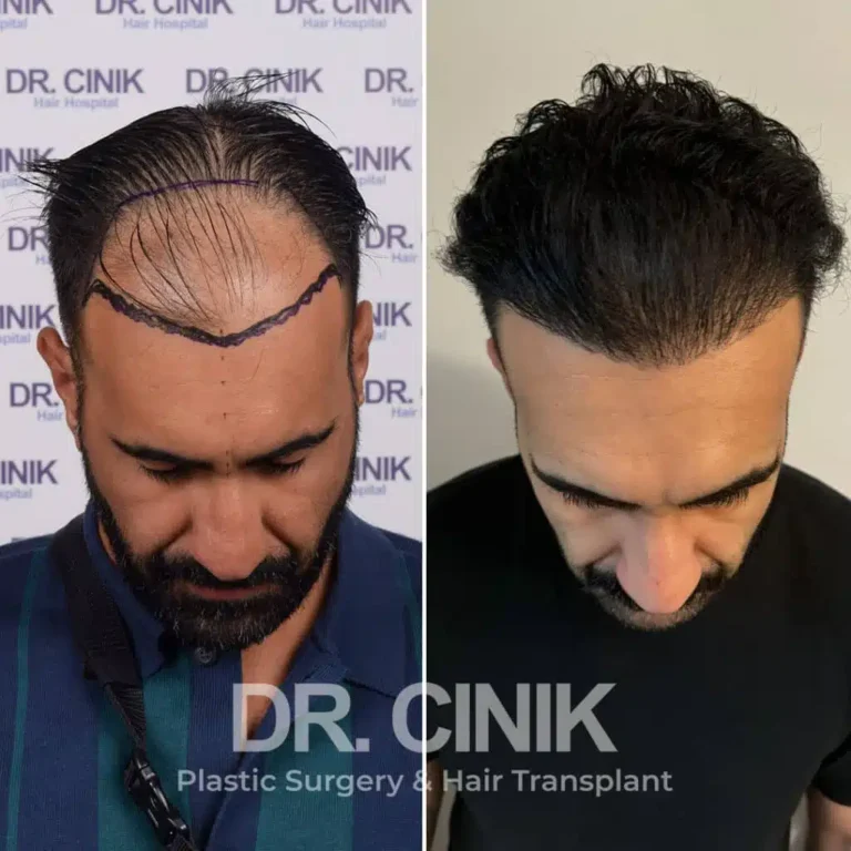 Greffe de cheveux DHI avant-après : 4000 greffons