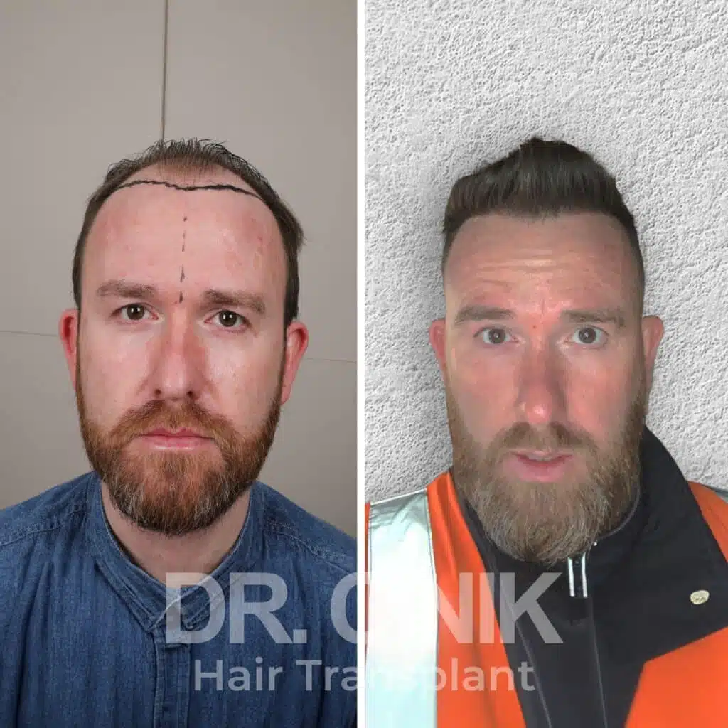 Greffe de cheveux FUE avant-après : 4300 greffons