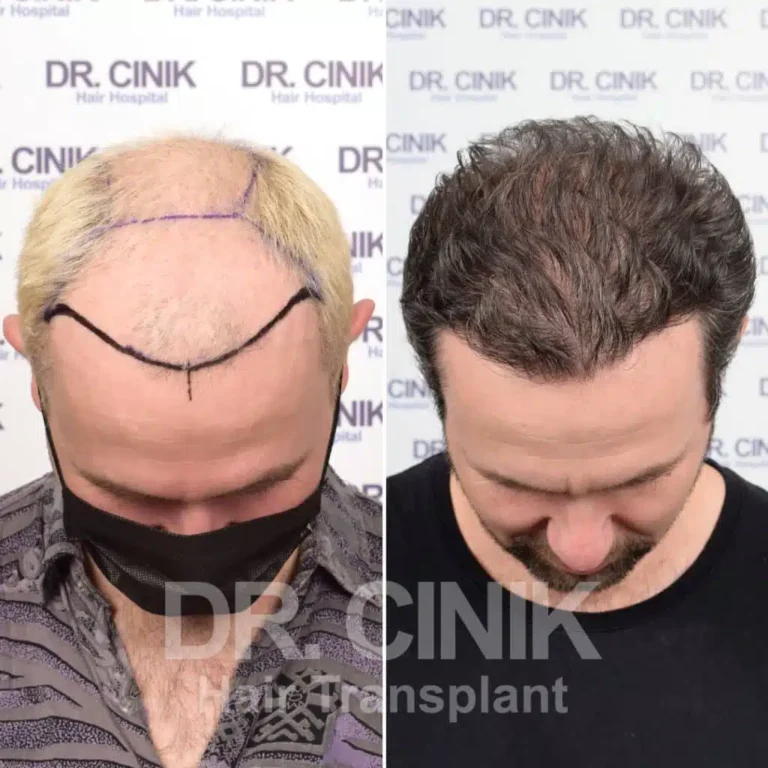 Greffe de cheveux FUE Saphir avant-après : 4800 greffons