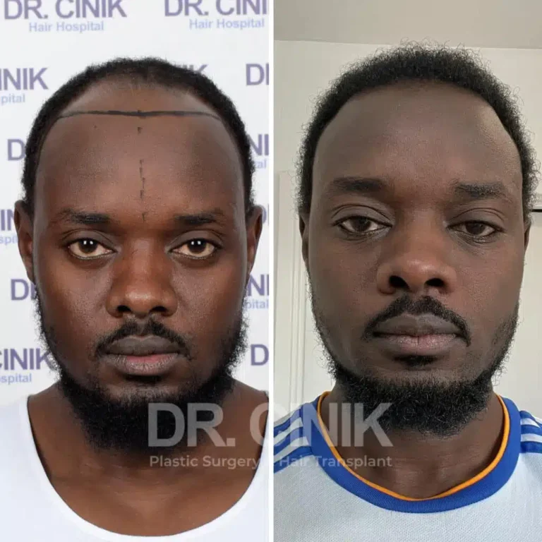 Greffe de cheveux afro avant-après : 2725 greffons